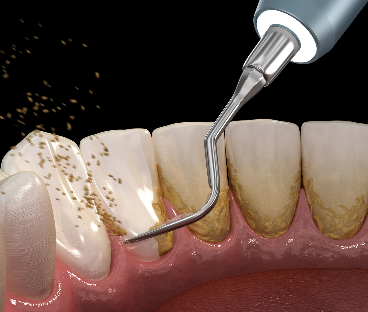 Alisa Teeth Stone: What is it and How to Solve the Problem?