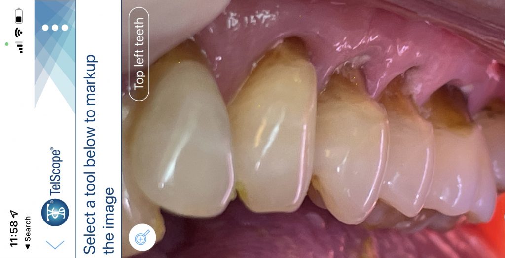 Alisa Teeth Stone: What is it and How to Solve the Problem?